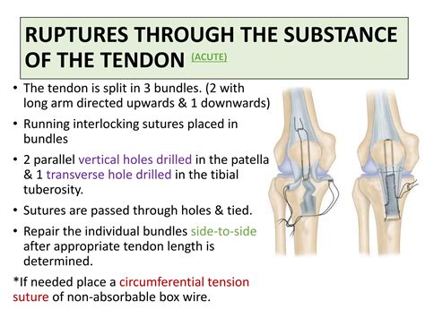 Patellar and quadriceps tendon rupture | PPTX