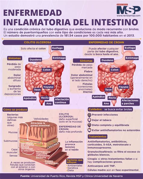 Enfermedad inflamatoria del intestino - Infografía