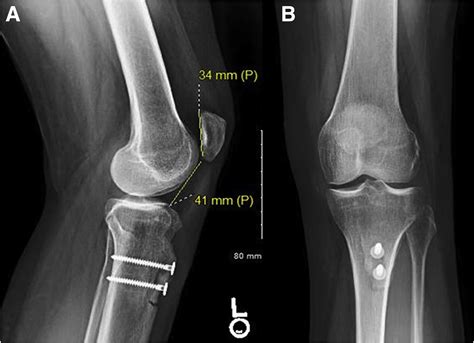 Tibial Tubercle Osteotomy With Anteriorization and Distalization for ...
