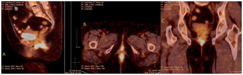 Primary Vaginal Mucinous Adenocarcinoma of Intestinal Type—Clinical ...