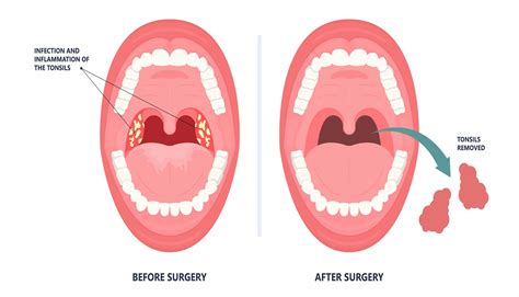 Tonsil Removal Surgery