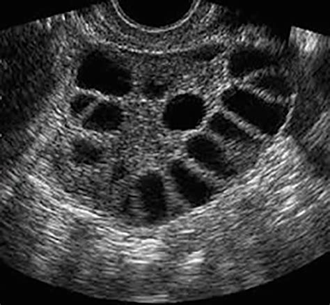 Ultrasound Of Pcos Ovary