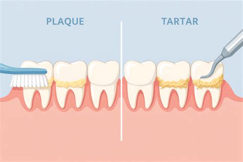 Plaque vs. Tartar: What’s the Difference?
