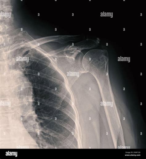 X-ray Shoulder joint shoulder front view for diagnosis fracture of ...