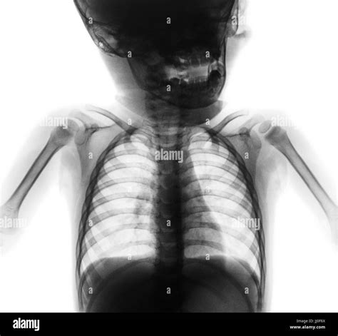 Infant Chest X Ray Normal at Maddison Westacott blog