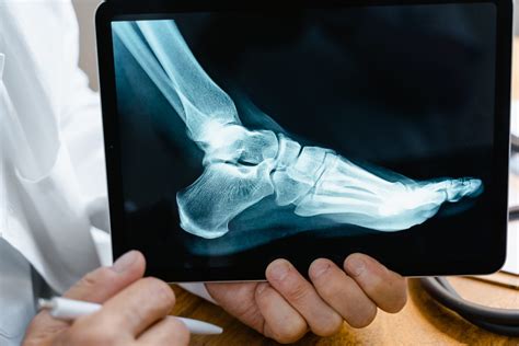 3 Common Bunion Surgery Complications | The Bunion Cure