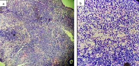 Endometrial pathology in postmenopausal women: Analysis of 112 cases in ...