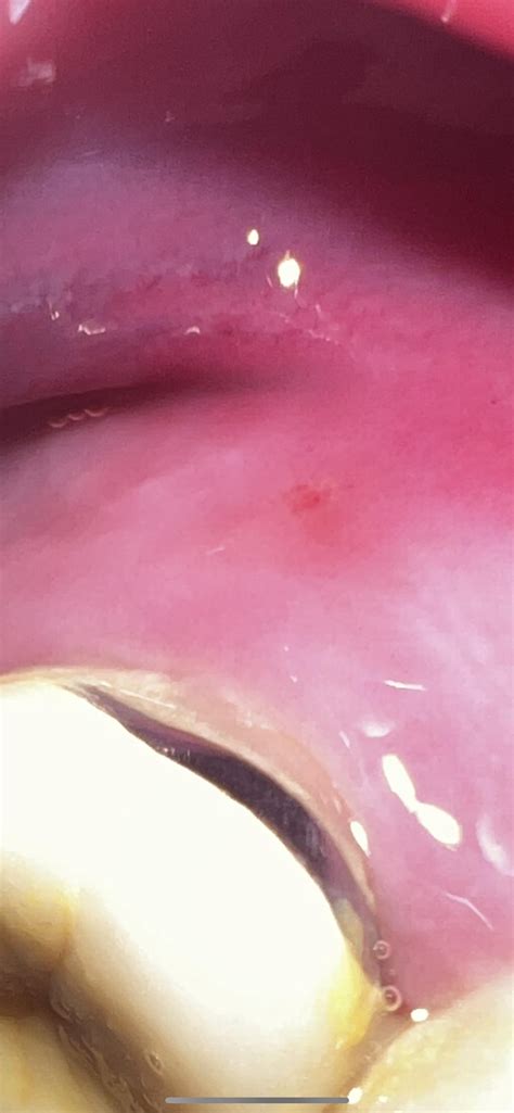 Can someone tell me what this is? Noticed like a week ago. Went to the dentist and while I was ...