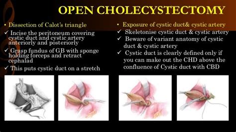 Open Cholecystectomy 的图像结果