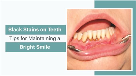 Brighten Your Smile: How to Deal with Black Stains on Teeth