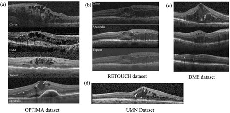 A Review of Machine Learning Algorithms for Retinal Cyst Segmentation ...