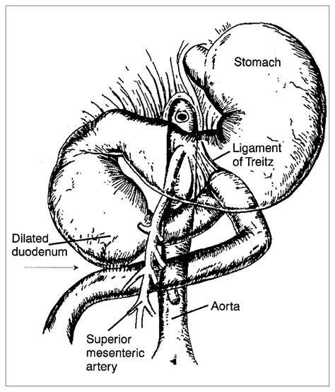 Ligament Of Treitz Cadaver Duodenum | Anatomy.app