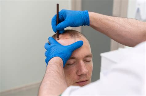 Hairline Varieties: A Comprehensive Guide