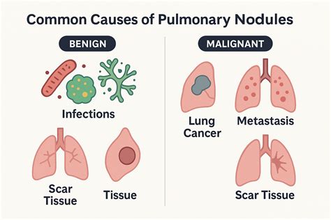 Pulmonary Nodules: Complete Guide to Diagnosis, Risk & Management