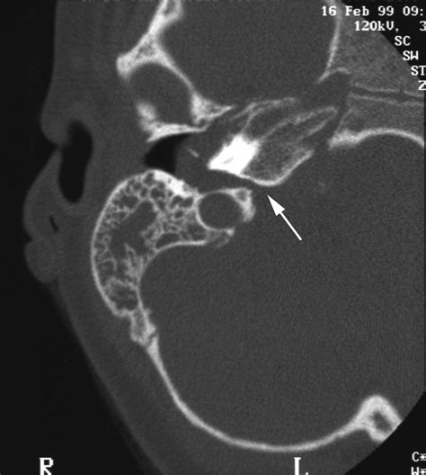 Spinal Fluid Leaking From Ears Cerebrospinal Fluid Leak Imaging: