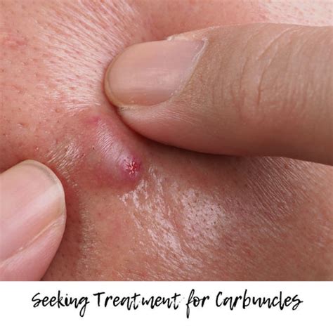 Image result for Removing Carbuncle