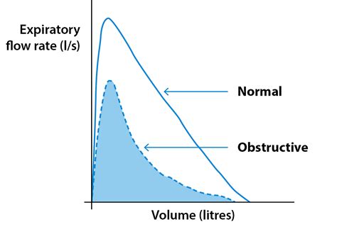 Spirometry Test Asthma