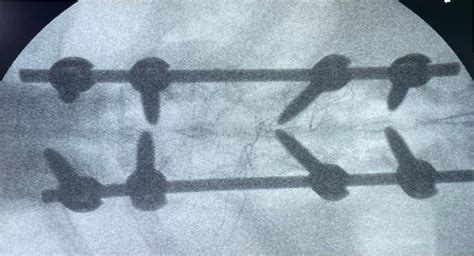 Best Spinal Infection Surgeon in Chennai