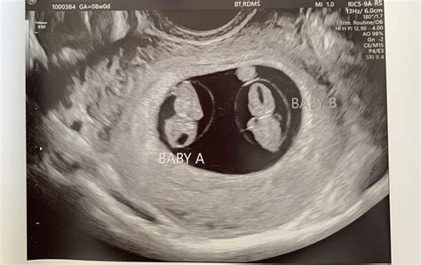 Ultrasound Twins 9 Weeks