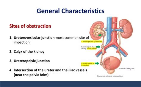 Nephrolithiasis - urinary stones | PPTX