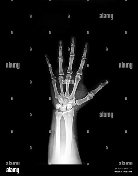 X-ray hand AP view normal Stock Photo - Alamy