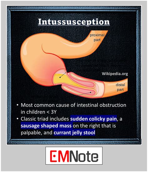 Image result for Intussusception Symptoms