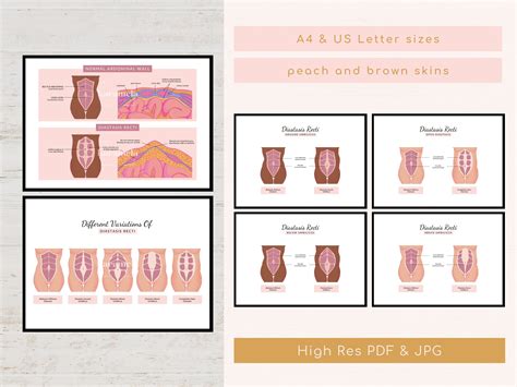 Diastasis Recti Variations Diagram | Abdominal Muscles Separation ...