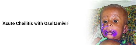 Acute Cheilitis with Oseltamivir