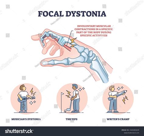 Focal Hand Dystonia
