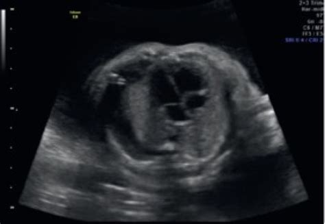 Pleural Effusion | Texas Children's