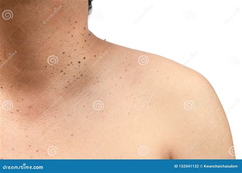 Closed Up the Skin Tags or Seborrheic Keratosis on Neck Stock Photo - Image of examination ...
