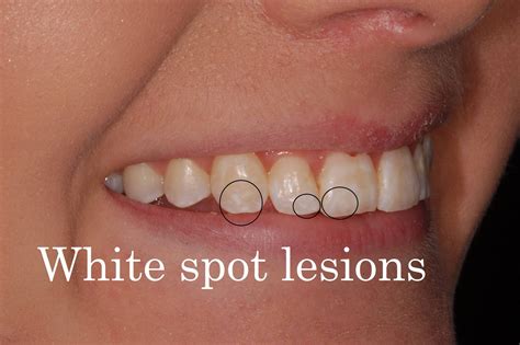 White spots teeth? What are they and how do you get rid of them?