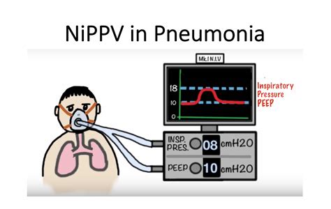 emDOCs.net – Emergency Medicine Educationnoninvasive positive pressure ...