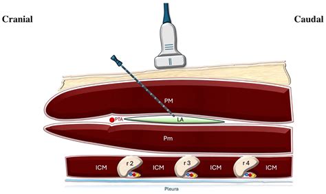 Optimizing Analgesia After Minimally Invasive Cardiac Surgery: A ...