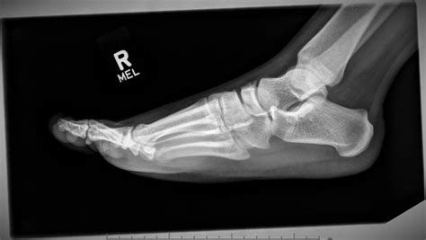 Navicular Bone Fracture Boot at Lucy Doak blog
