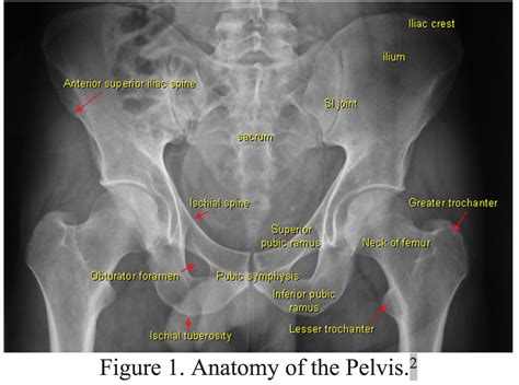 Superior Pubic Ramus Fracture Pelvic Fractures: ED Presentations And