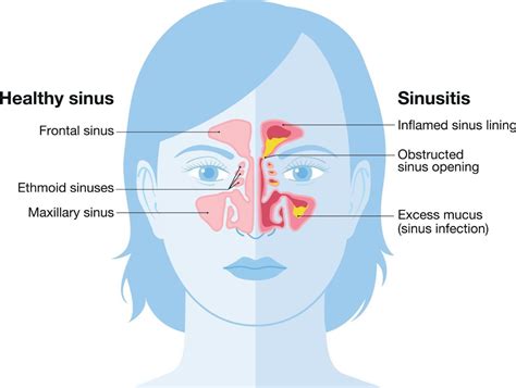 Is It Sinusitis or Allergic Rhinitis? Here’s How To Tell The Difference - Allergy & Sinus ENT ...