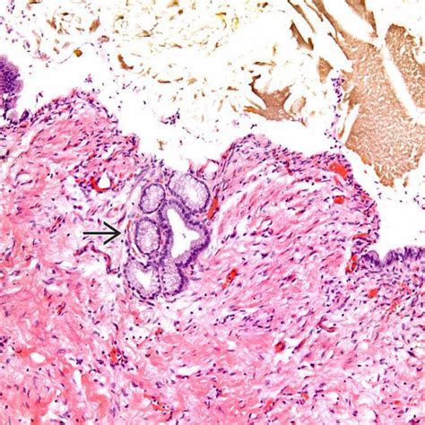 Inflammatory Polyps | Basicmedical Key