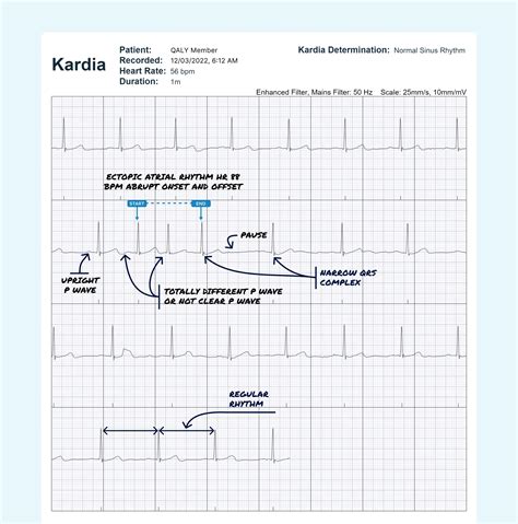 Borderline Ecg