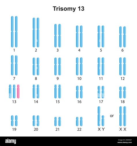 Scientific Designing of Patau Syndrome (Trisomy 13) Karyotype. Colorful ...