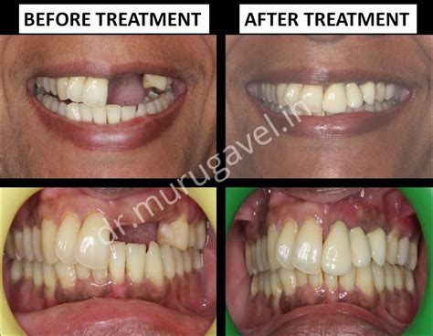 » Multiple teeth replacement with basal implants