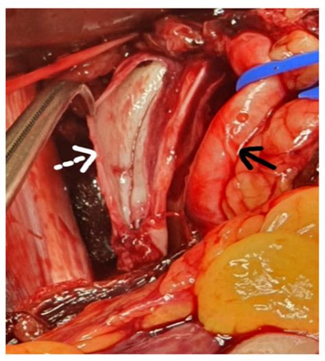 Spontaneous Left External Iliac Vein Rupture