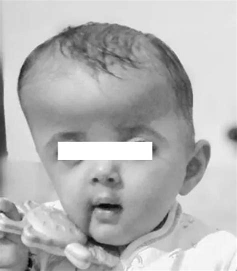 The Head Shape Clinic - Apert Syndrome, Crouzon Syndrome, Craniosynostosis