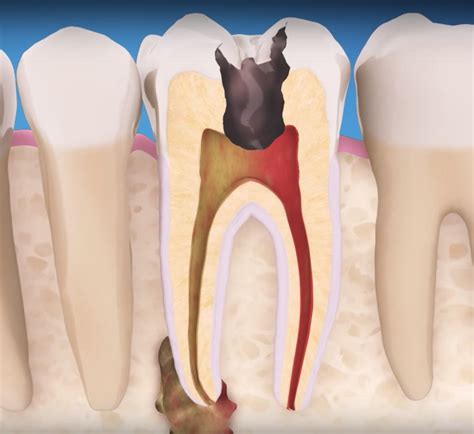 Root Canal Therapy To Rescue Your Teeth - Dentalopolis Spring TX
