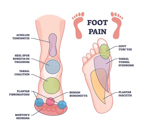Ultimate Guide to Foot Pain Relief: When to Rest and When to See a Doctor - Arch Support One