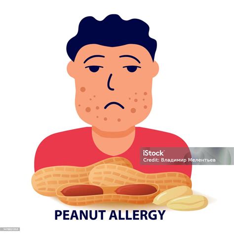 Nut Allergy Symptoms Problem Swollen Man Character Stock Illustration - Download Image Now - iStock