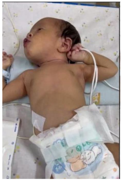 Managing Neonatal Varicella: A Case Series Highlighting the ...