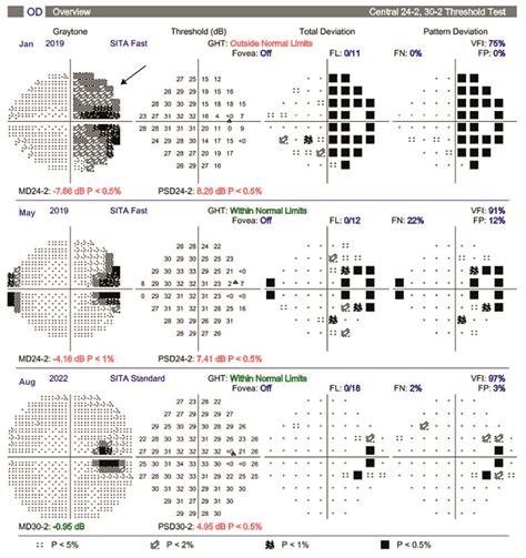 Image result for Peripheral Vision Test Results