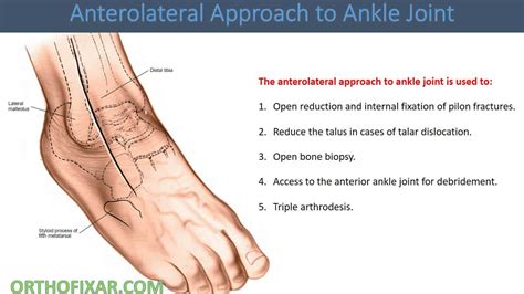 Image result for Ankle Anterolateral Approach Injection