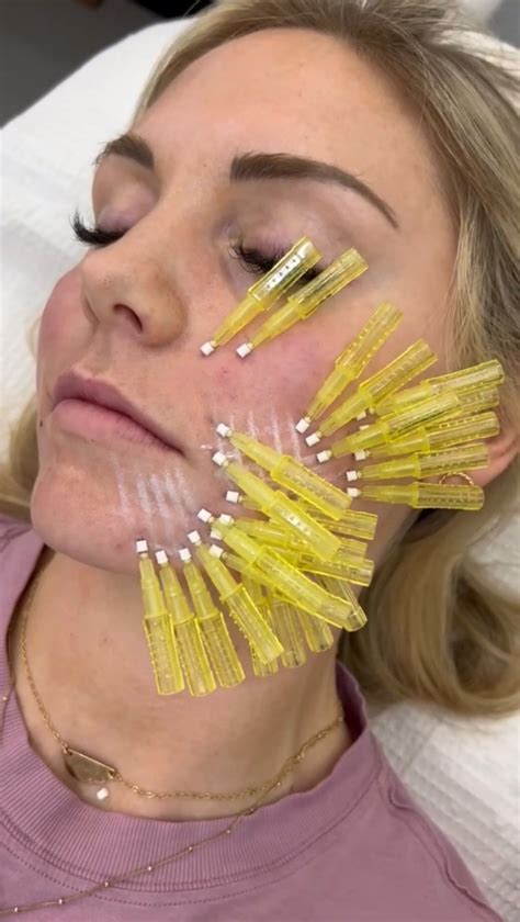 Pdo thread lift procedure in boca raton – Artofit